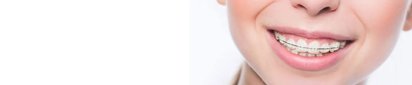 Sorriso con apparecchio dentale, trattamento odontoiatria Cuneo presso Centro Medico Europeo.